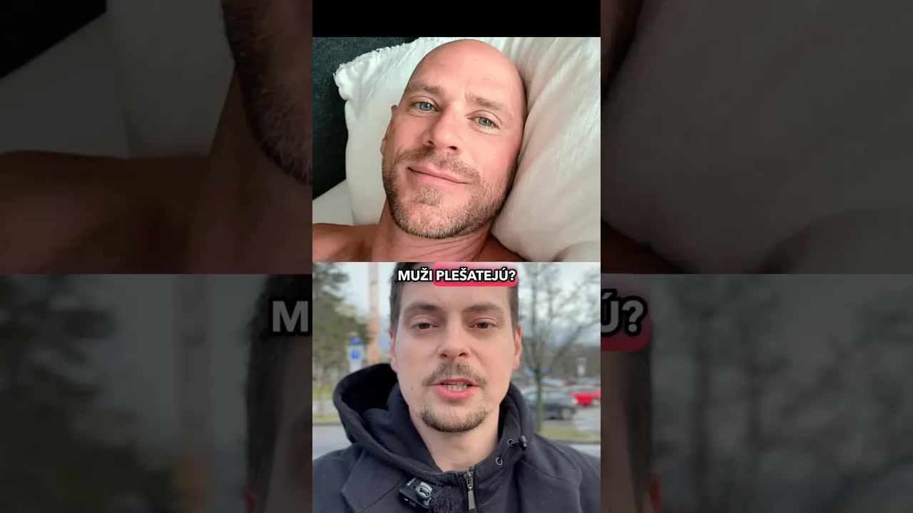 Prečo muži plešatejú: Genetika a hormóny