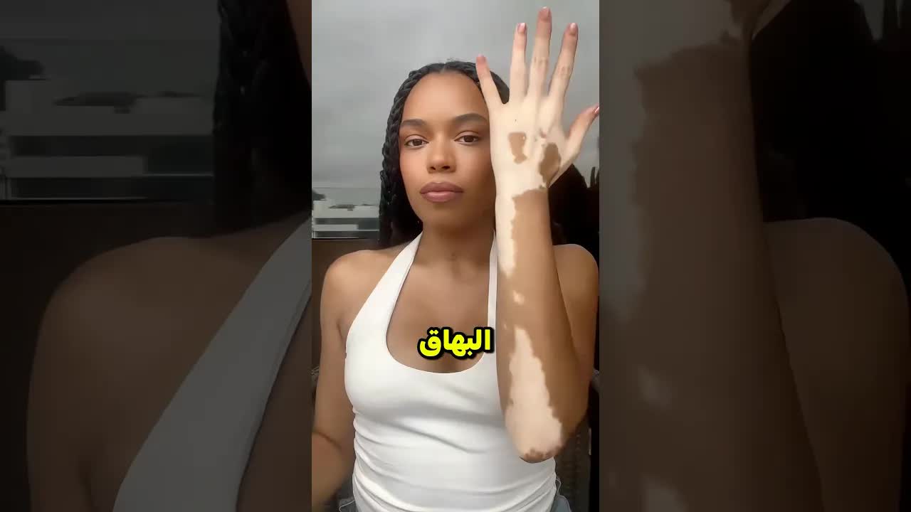 فتاة حولت بقع البهاق إلى فن