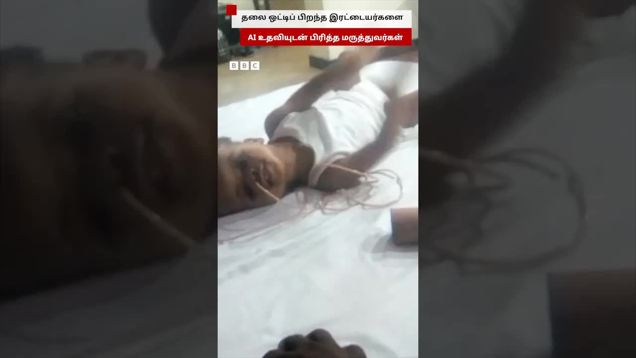 AI உதவியுடன் தலை ஒட்டிய இரட்டையர்கள் பிரிப்பு