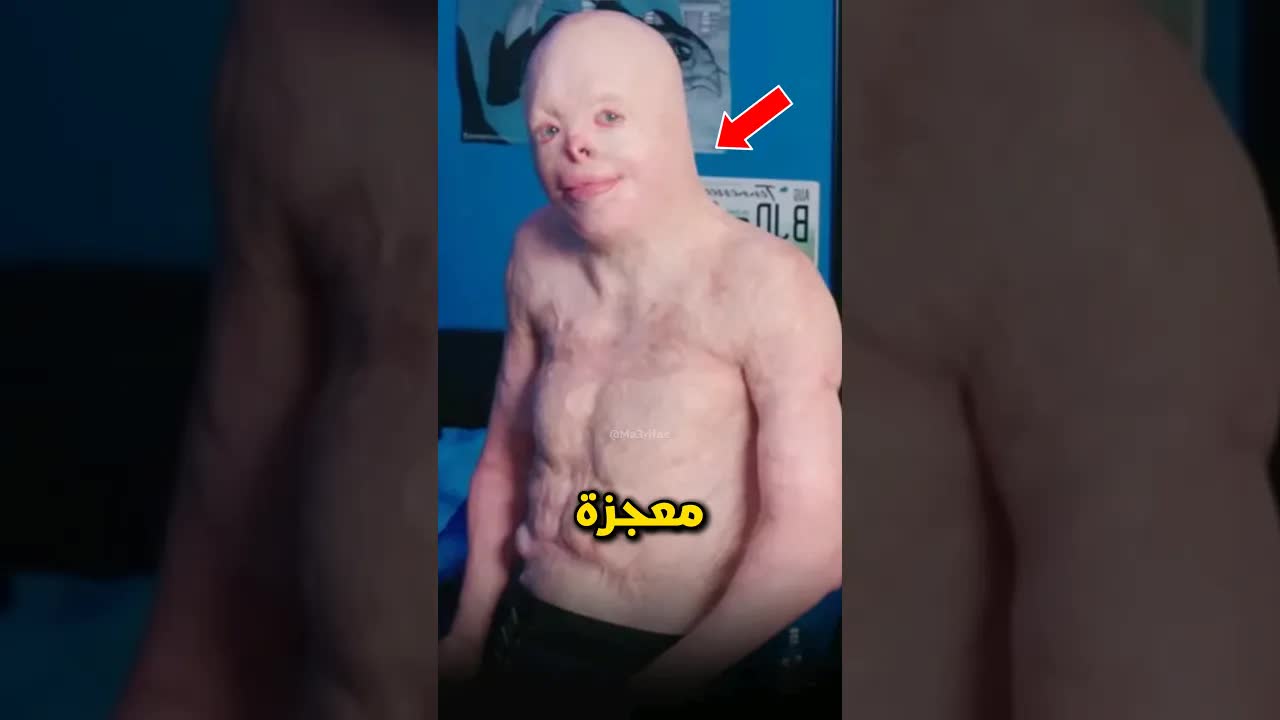 قصة جوني: معجزة النجاة من الحروق