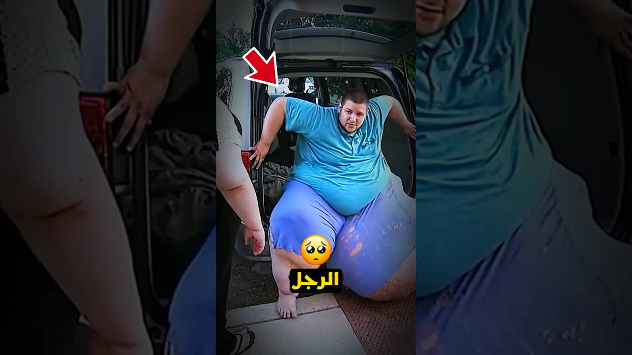 هذا الرجل لديه 150 رطلا من الوذمة في ساقه