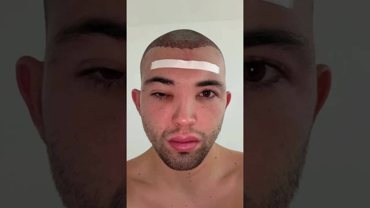 Mi recuperación de injerto capilar en 7 días