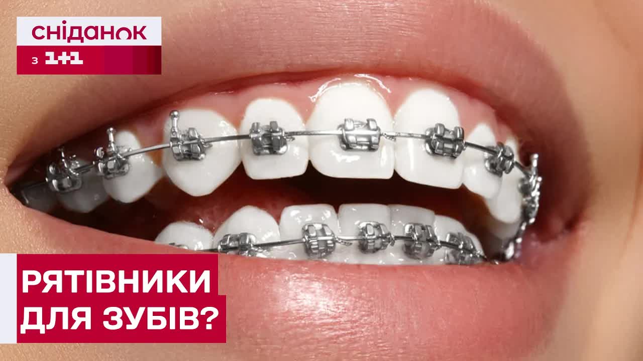 Догляд за брекетами у підлітків: поради стоматолога