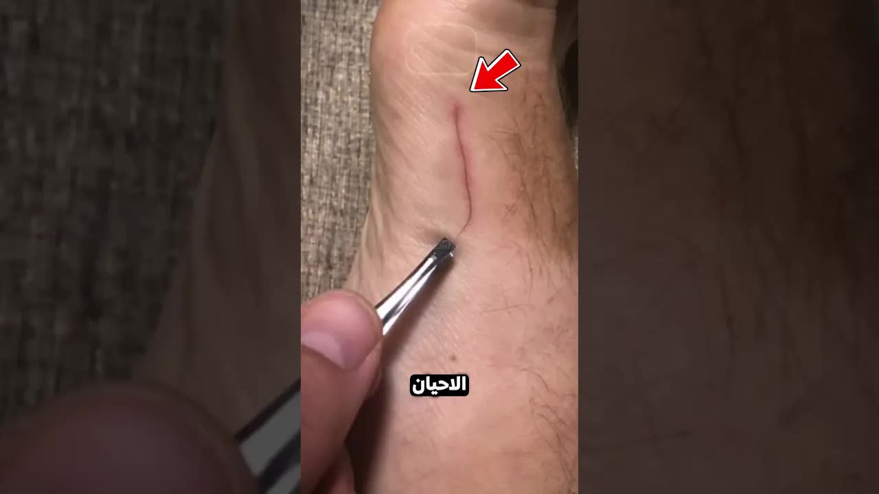إذا رأيت هذا الشيء تحت جلدك، أزله فورًا