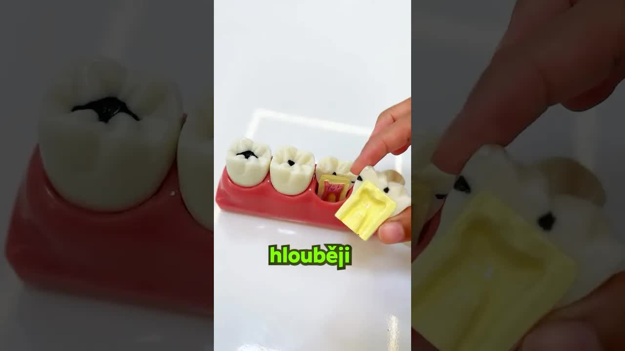 Jak zubní kaz ničí zuby krok za krokem