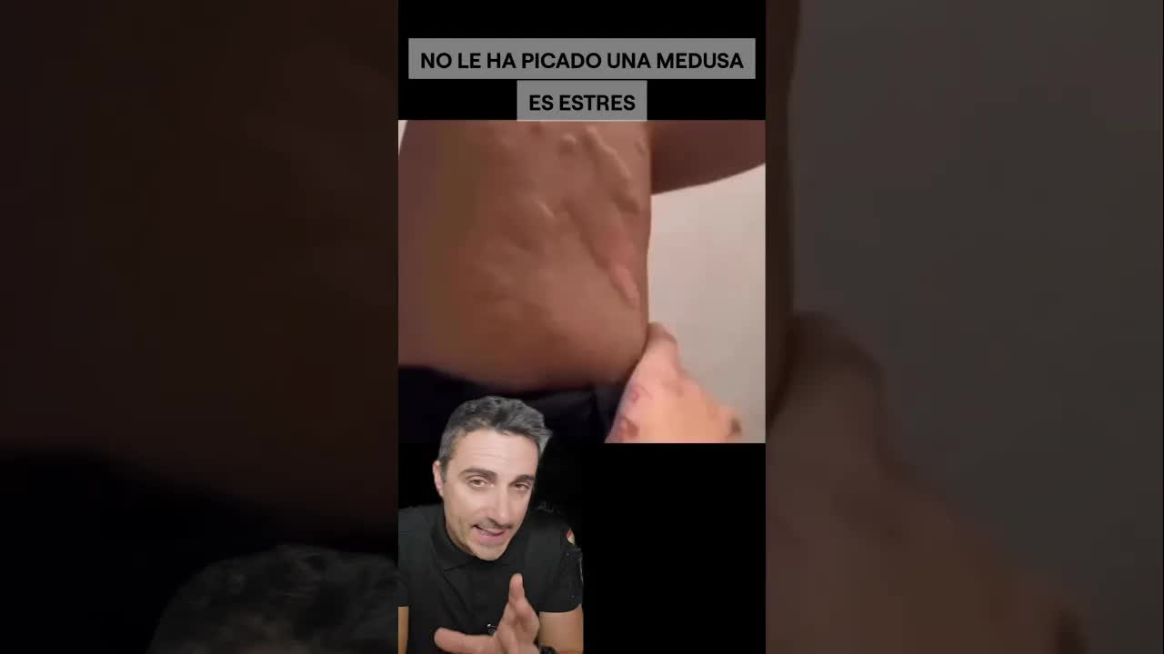 Qué es la urticaria por estrés
